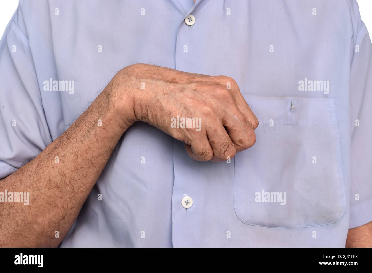 Rigidità muscolare della mano e flessione delle dita dell'anziano asiatico. Foto Stock