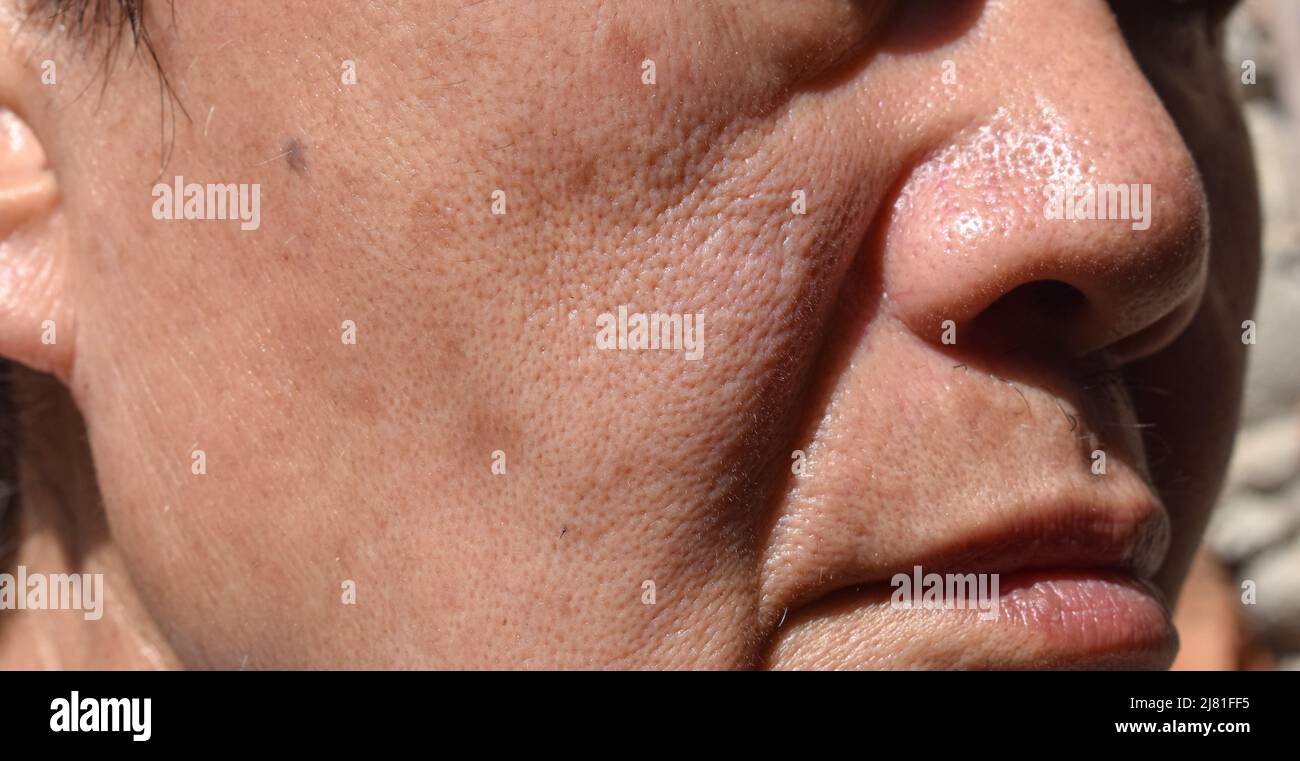 Piccole macchie marroni chiamate macchie di età sulla faccia dell'anziano asiatico. Sono anche chiamati macchie di fegato, lentigo senile, o macchie di sole. Primo piano. Foto Stock