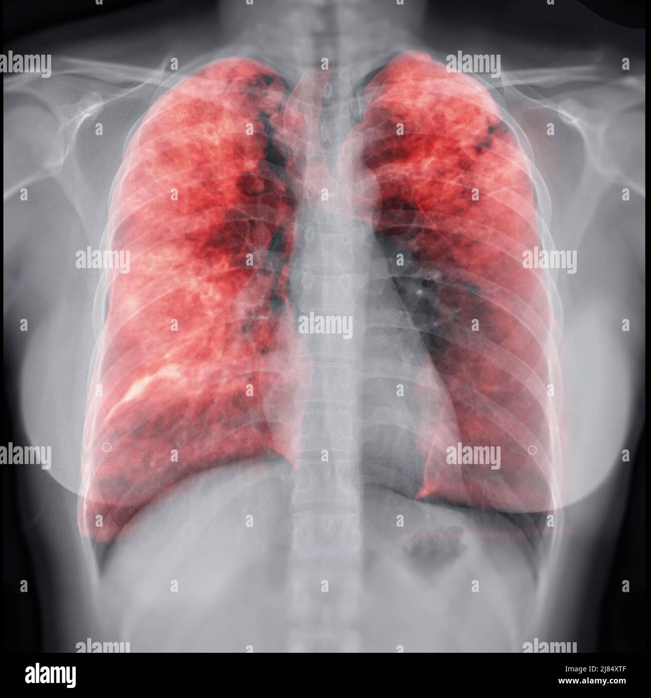 Radiografia toracica con Lung 3D rendering immagine per diagnosi TB,tuberculosis e covid-19 . Foto Stock