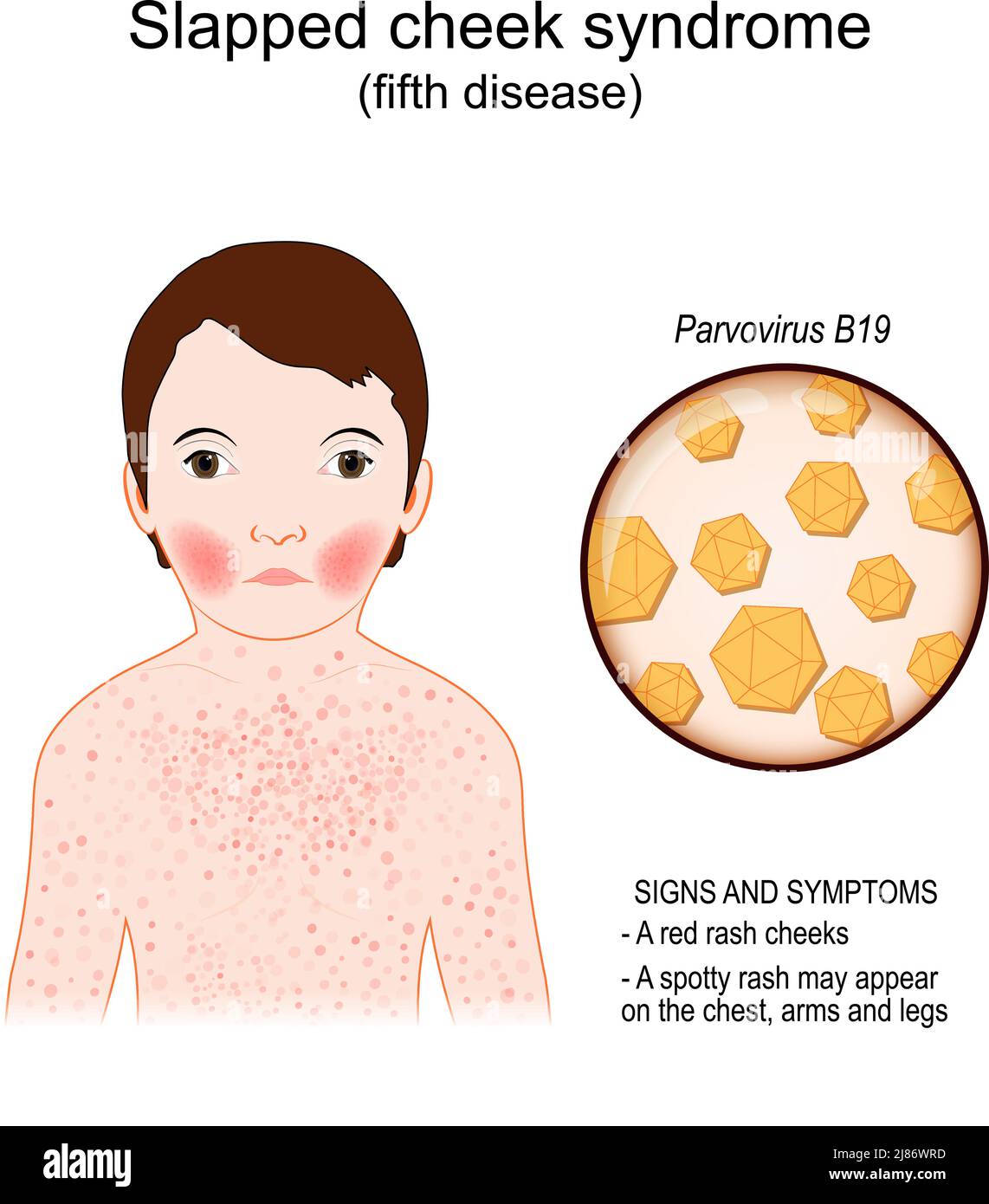 Quinta malattia. Segni e sintomi il bambino ha schiaffo sindrome della guancia. Malattia infettiva. Primo piano di Parvovirus B19. Illustrazione vettoriale Illustrazione Vettoriale