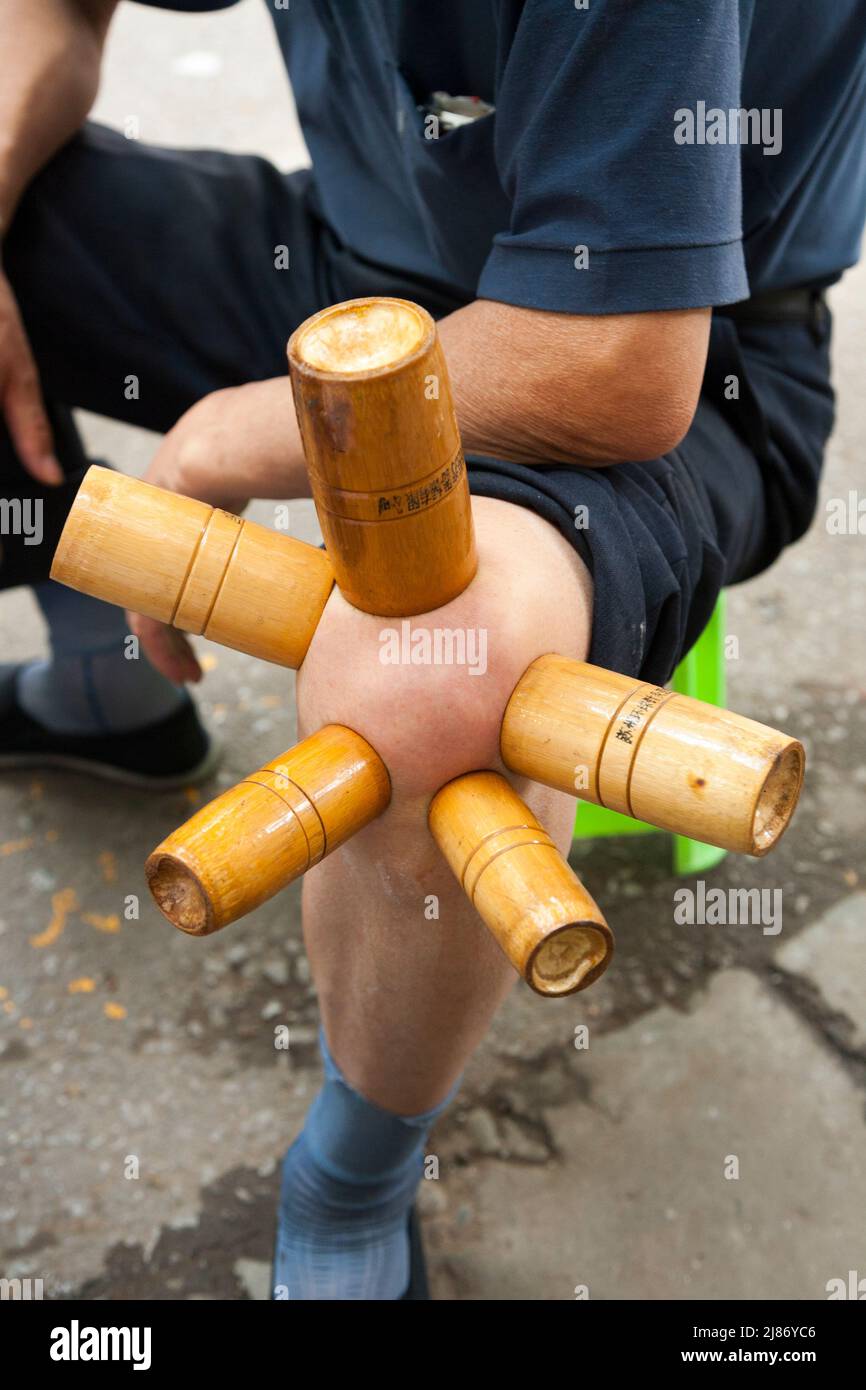 Usando la terapia di cupping ( trattamento di depressione bassa pressione ) per alleviare i sintomi dei problemi articolari del ginocchio e del dolore effettuati sulla strada in Xian / Xi'an, Cina. PRC. (125) Foto Stock