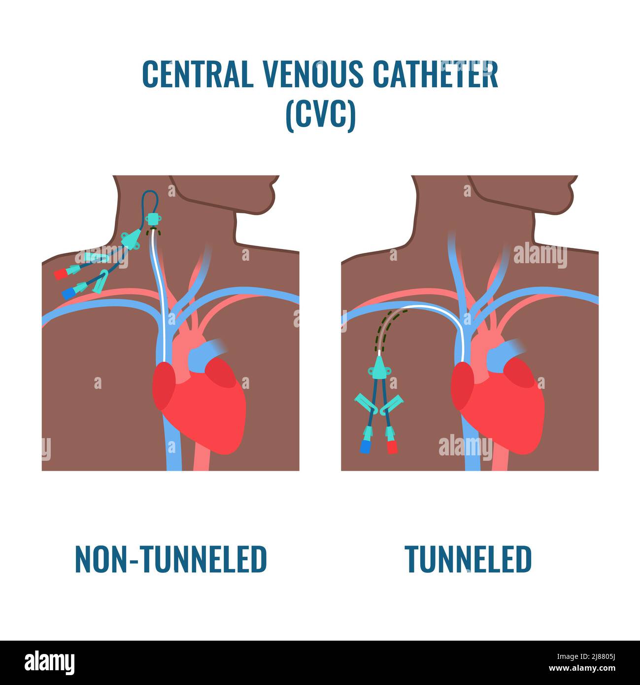 Catetere venoso centrale, illustrazione Foto Stock