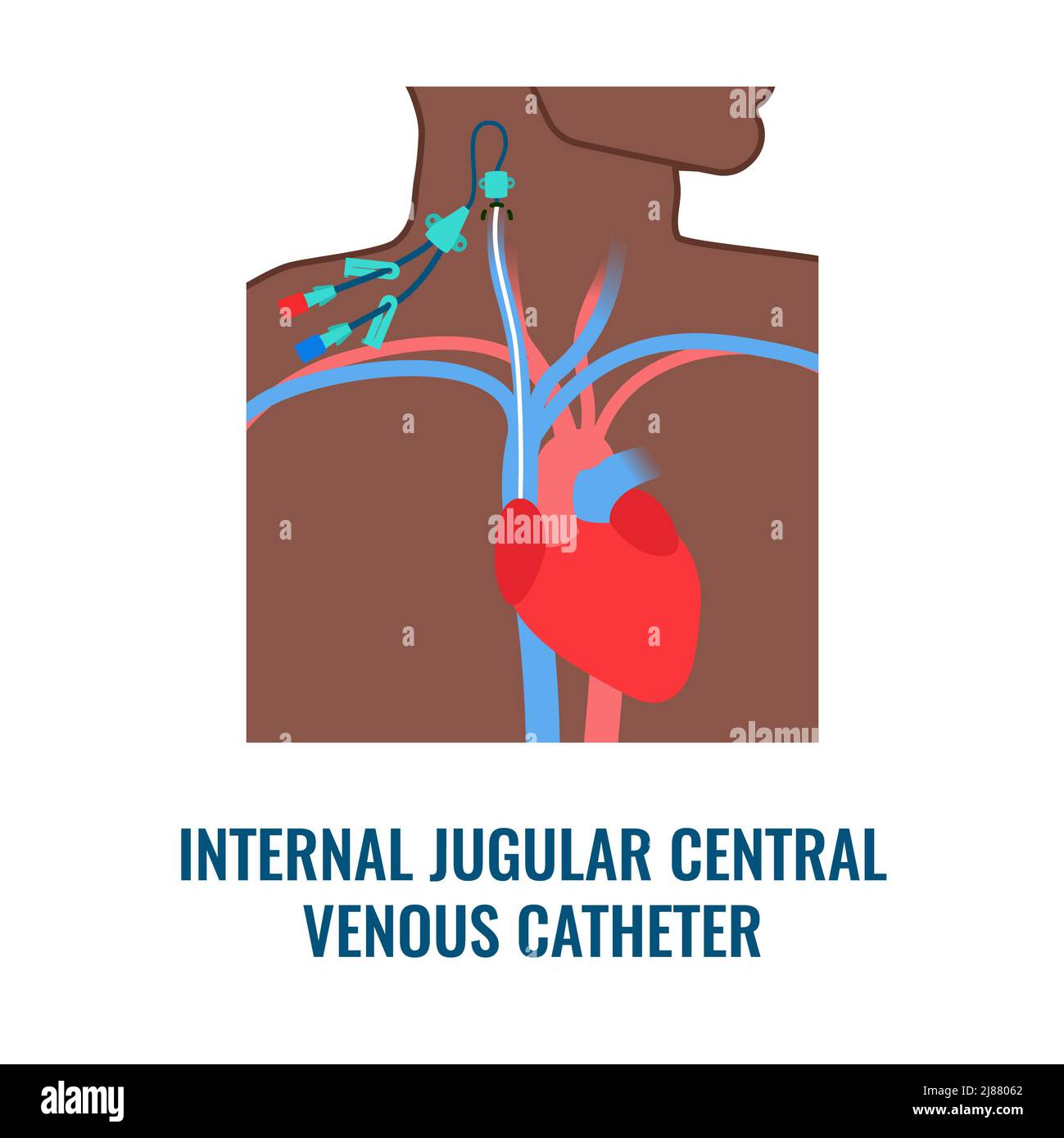 Catetere venoso centrale, illustrazione Foto Stock