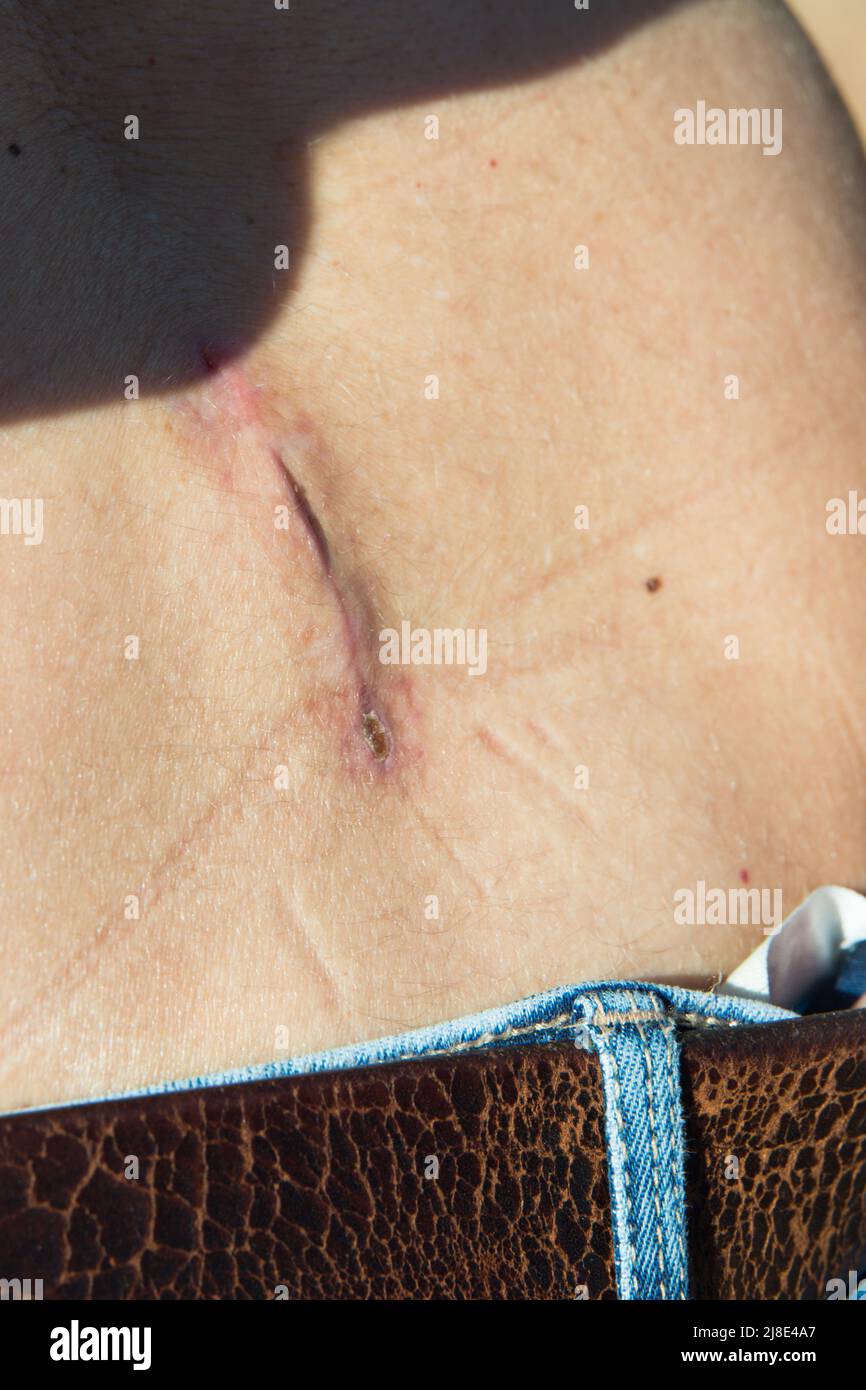 Primo piano di una cicatrice chirurgica sulla spina di una donna caucasica. Rimozione della cisti. All'aperto Foto Stock