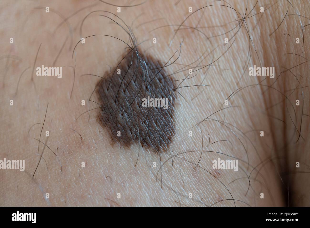 Grande talpa di pelle sulla gamba di un ragazzo giovane. Immagine macro. Foto Stock