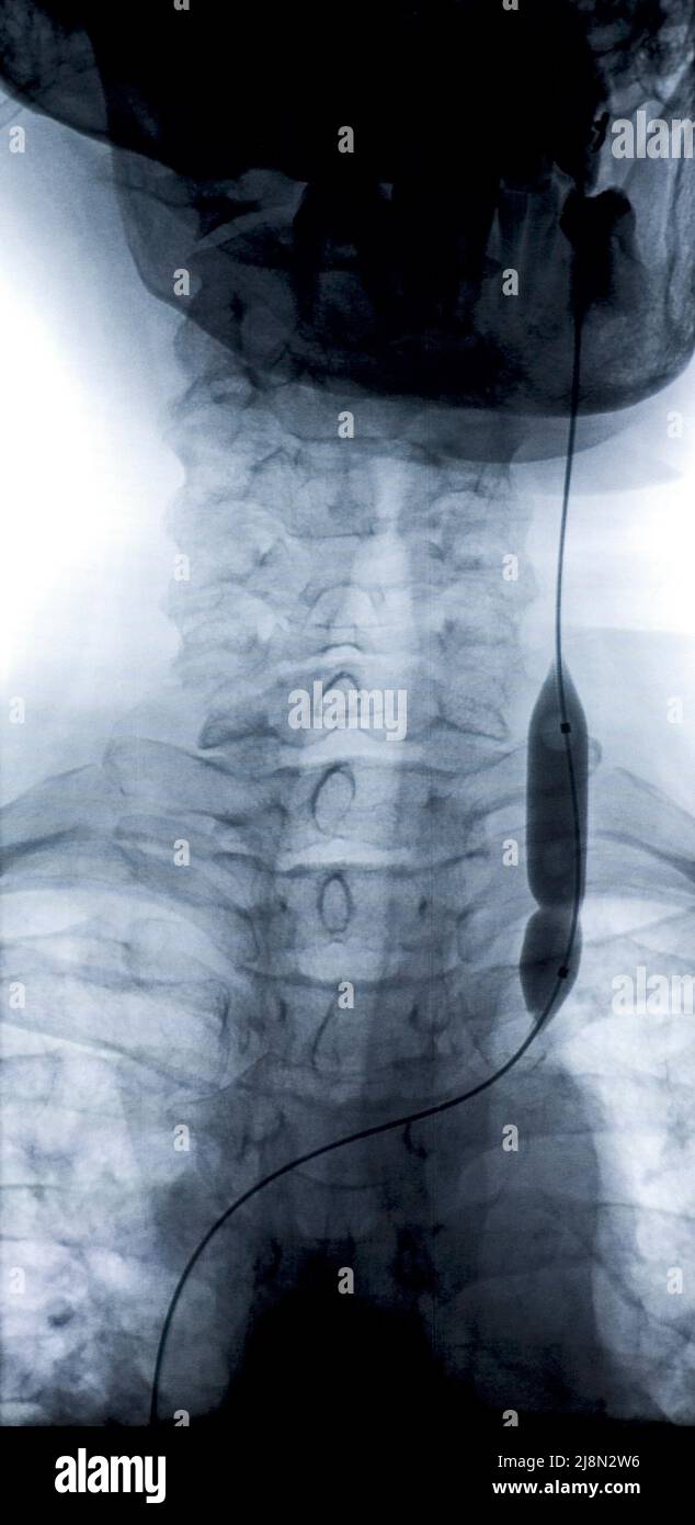 Ago 9, 2010. Catetere a palloncino utilizzato in angioplastica coronarica vista nell'immagine radiologica, nella vena giugulare interna di un paziente. (Foto CTK/Grzegorz Klatka) Foto Stock