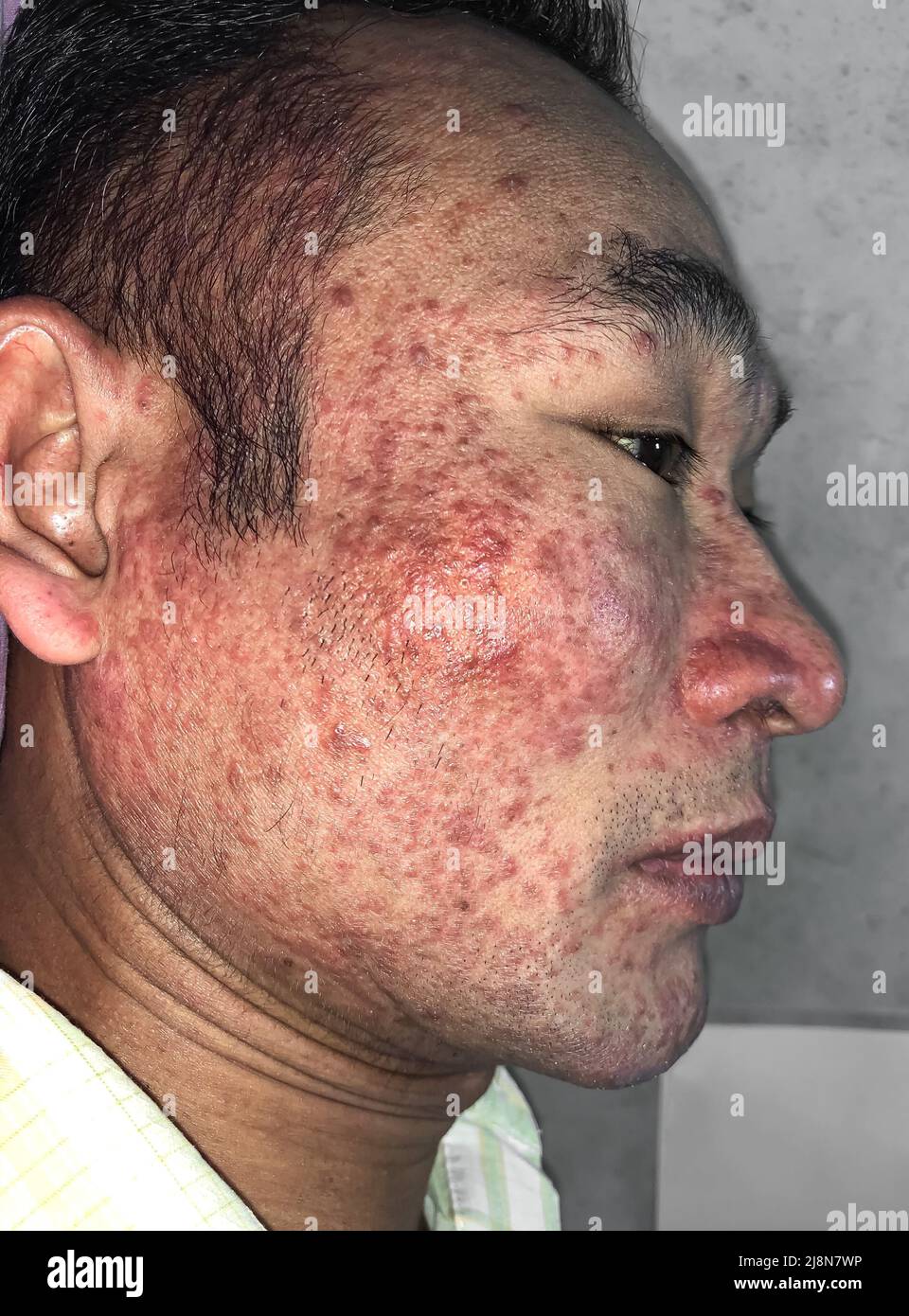Lesioni rosse da prurito acuto come acne gravi su tutta la faccia dell'uomo del sud-est asiatico. L'acne accade quando i follicoli dei capelli si ostruisce con olio e c morto Foto Stock