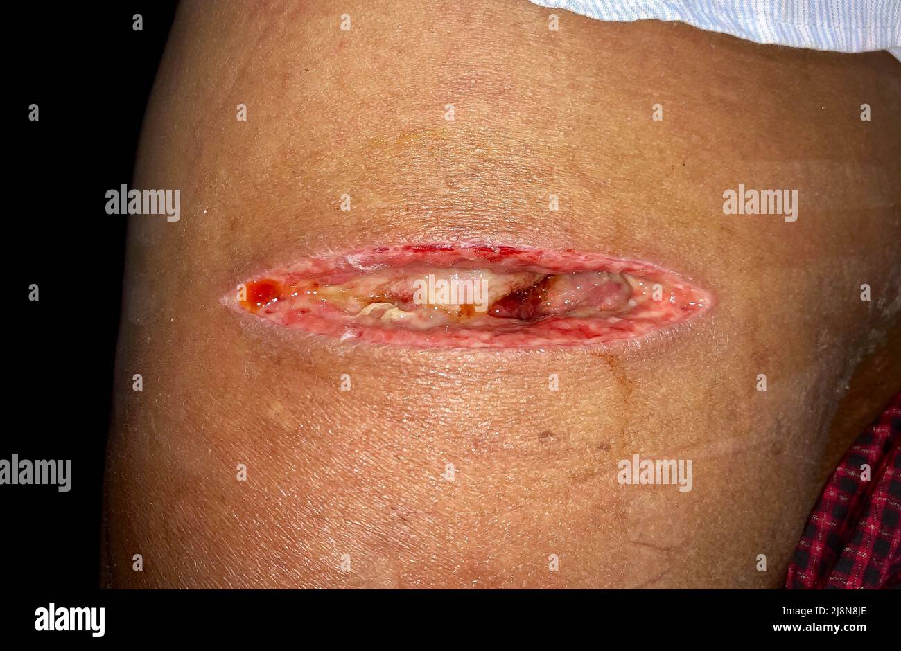 Ascesso post-intervento della ferita di iniezione. Scarsa guarigione della ferita e grande gaping. Foto Stock