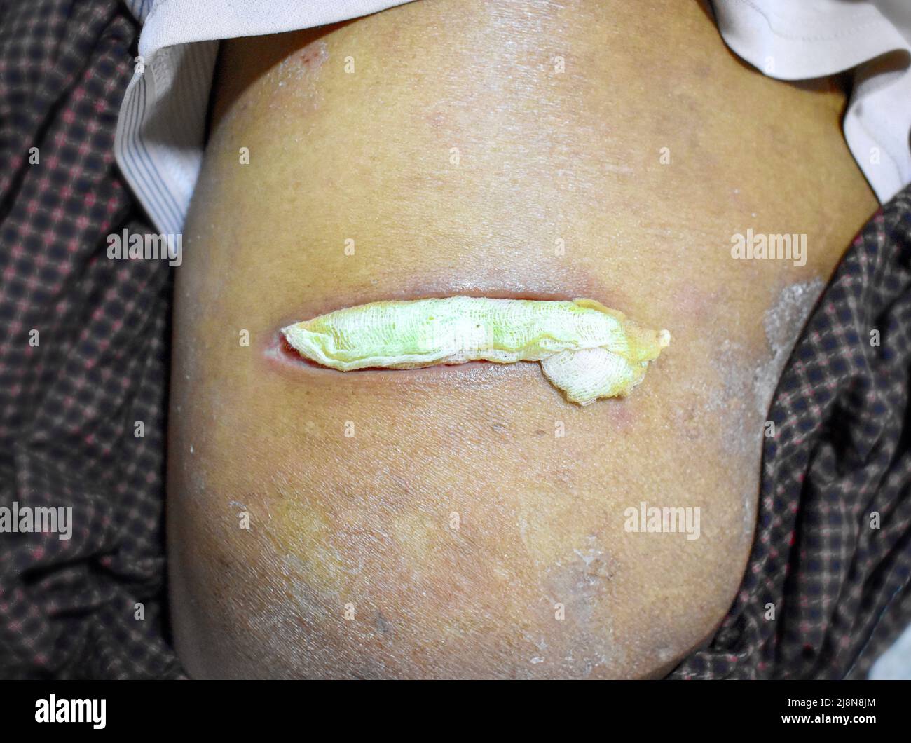Dopo l'intervento, la ferita di iniezione si abbatta con una garza di cotone inserita. Foto Stock