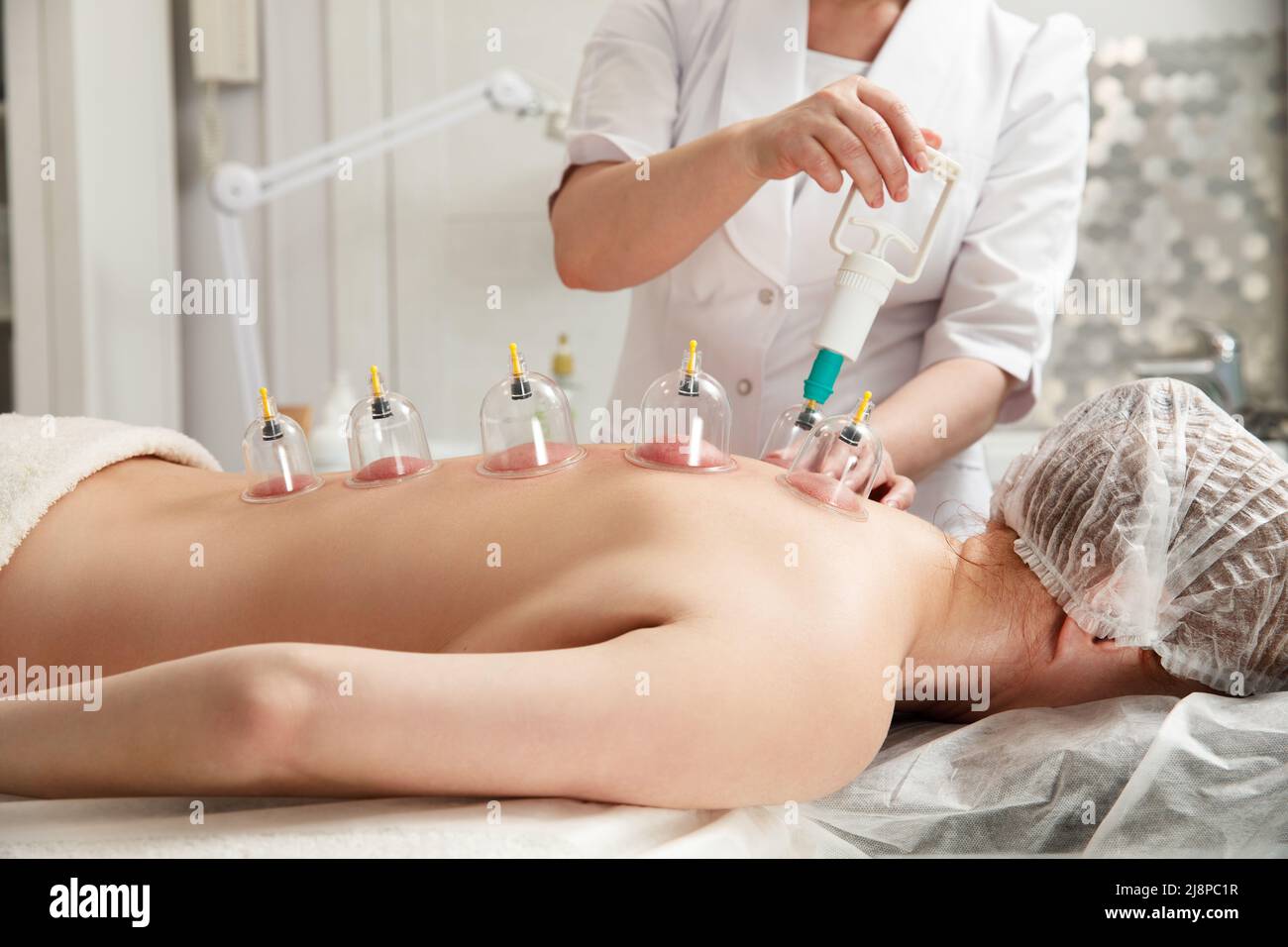 Massaggio sottovuoto. Coppe del vuoto di terapia medica di cupping sulla schiena della donna, primo piano, medicina cinese. Foto Stock