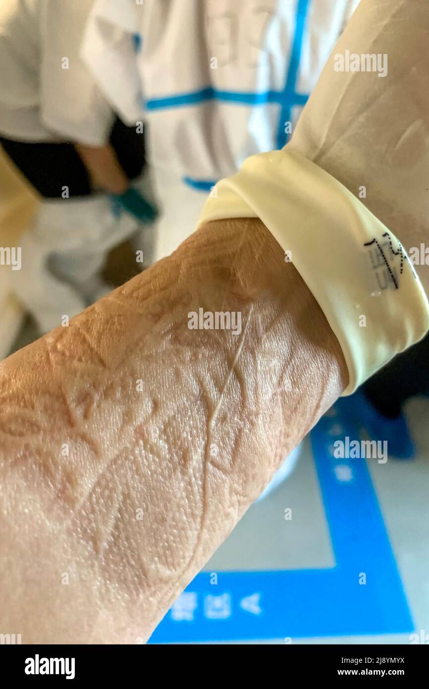 ANYANG, CINA - 19 MAGGIO 2022 - Un laboratorio di analisi degli acidi nucleici lascia segni profondi sul suo braccio dopo aver togli i suoi indumenti protettivi ad Anyan Foto Stock