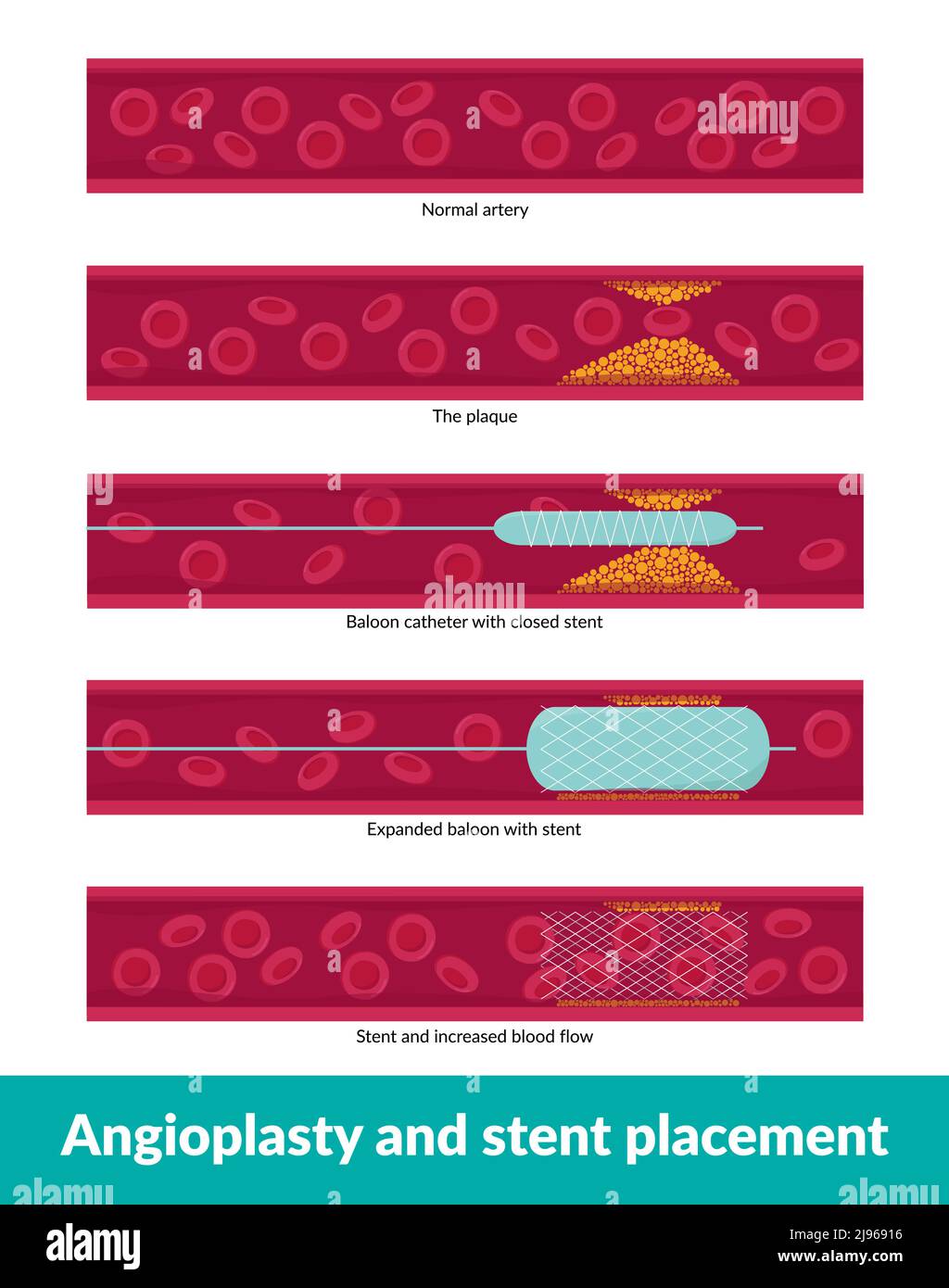 Angioplastica con posizionamento dello stent. Il piccolo catetere a palloncino viene inserito nel vaso sanguigno bloccato per ampliarlo e migliorare il flusso sanguigno Illustrazione Vettoriale