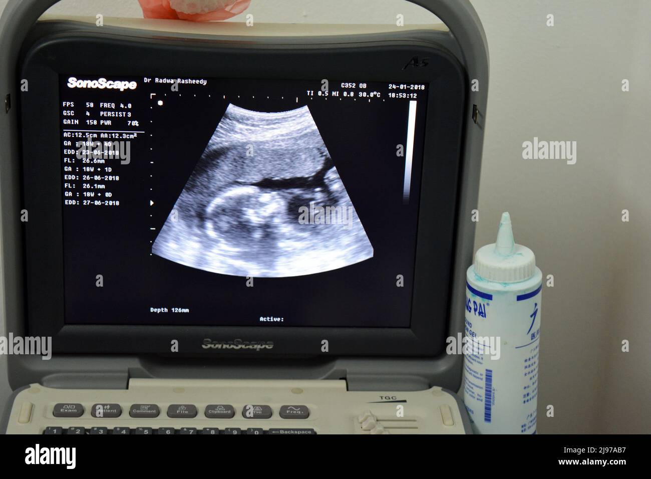 Cairo, Egitto, gennaio 24 2018: Un monitor di un'ecografia portatile che mostra la testa di un feto con un GA di età gestazionale 18 settimane e 4 giorni di durata Foto Stock