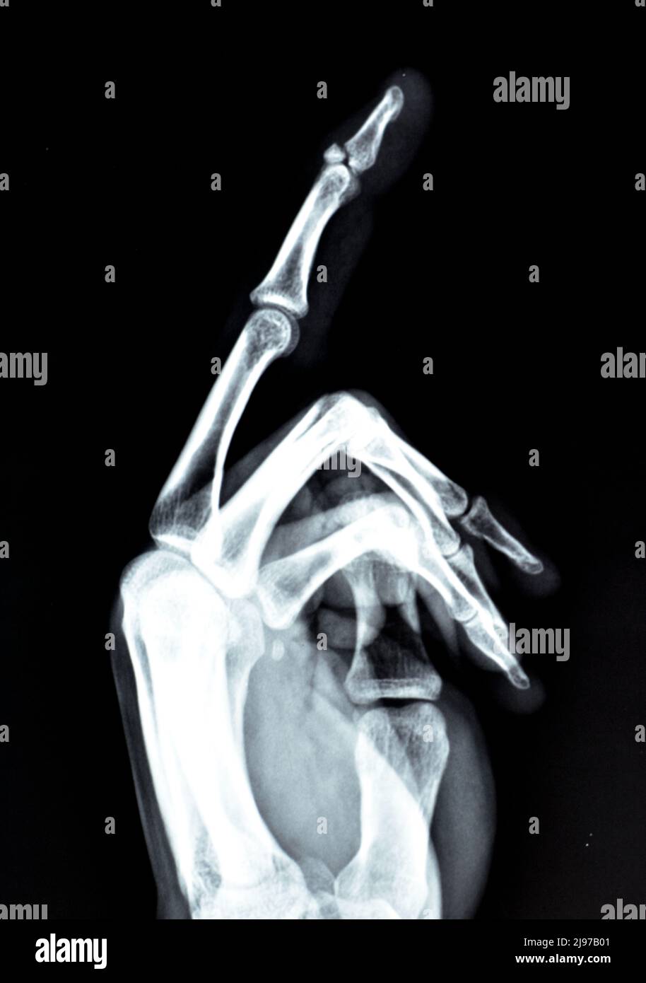 Frattura e spostamento di un piccolo pezzo di un osso della base della falanice distale del dito medio sinistro in una vista laterale di un raggio x semplice, s Foto Stock