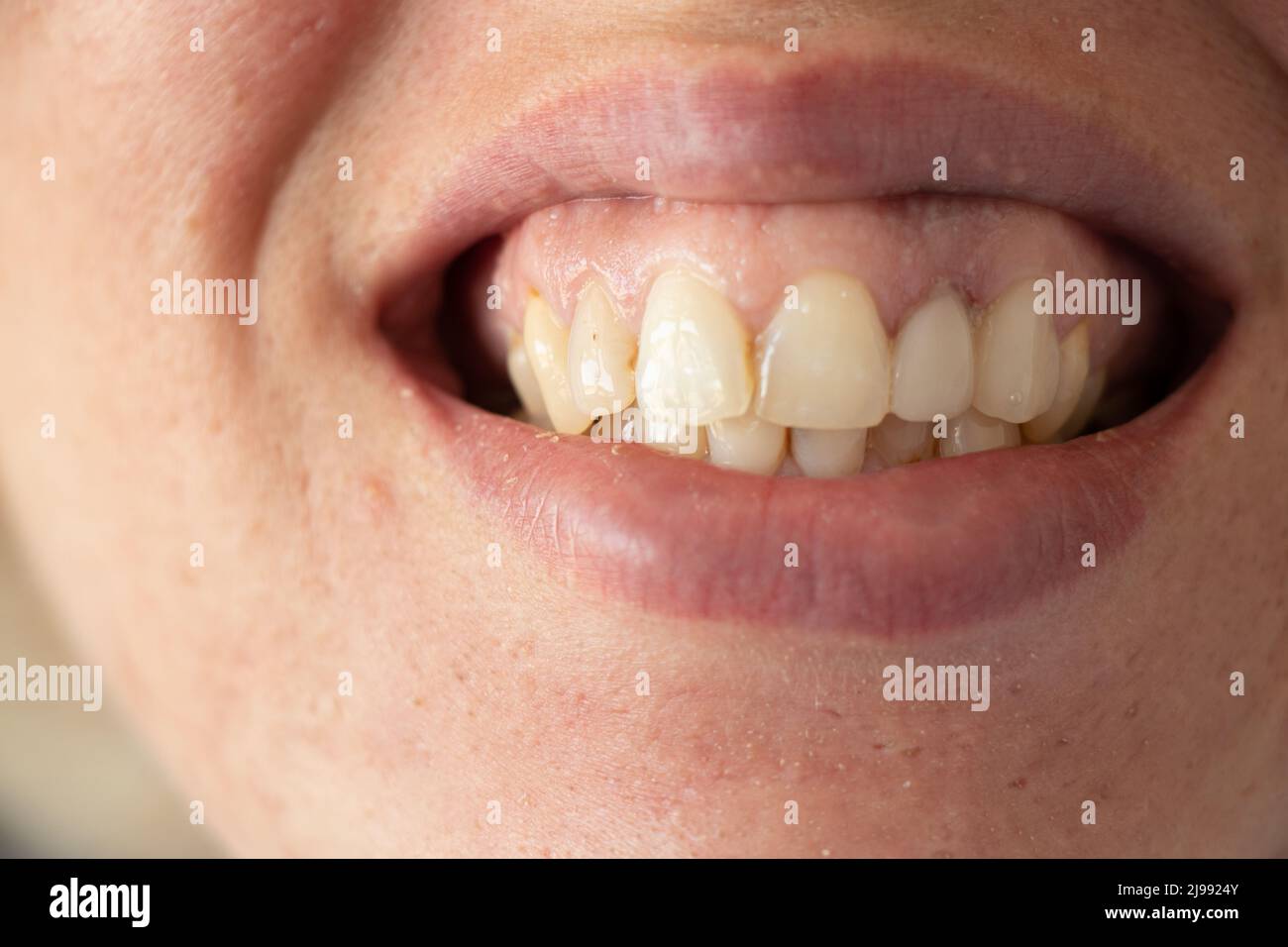 Denti gialli storti immagini e fotografie stock ad alta risoluzione - Alamy