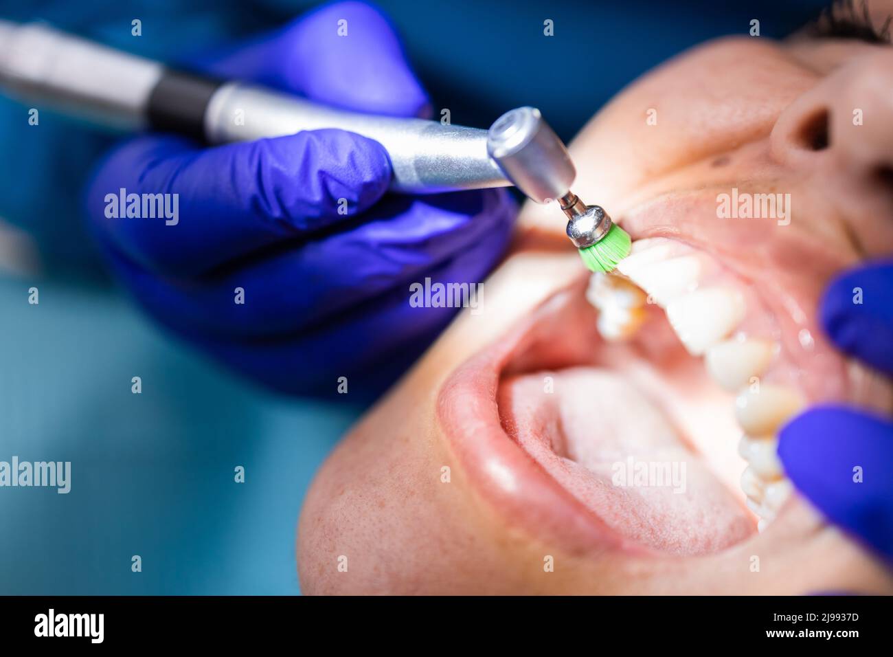 Dentista irriconoscibile che utilizza una spazzola per lucidatura dentale per lucidare e pulire i denti di una paziente Foto Stock