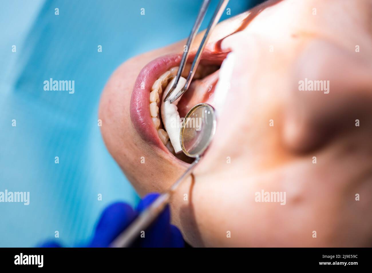 Dentista irriconoscibile che mette un rotolo di cotone dentale usando le pinzette e uno specchio della bocca ad una paziente femminile. Foto Stock