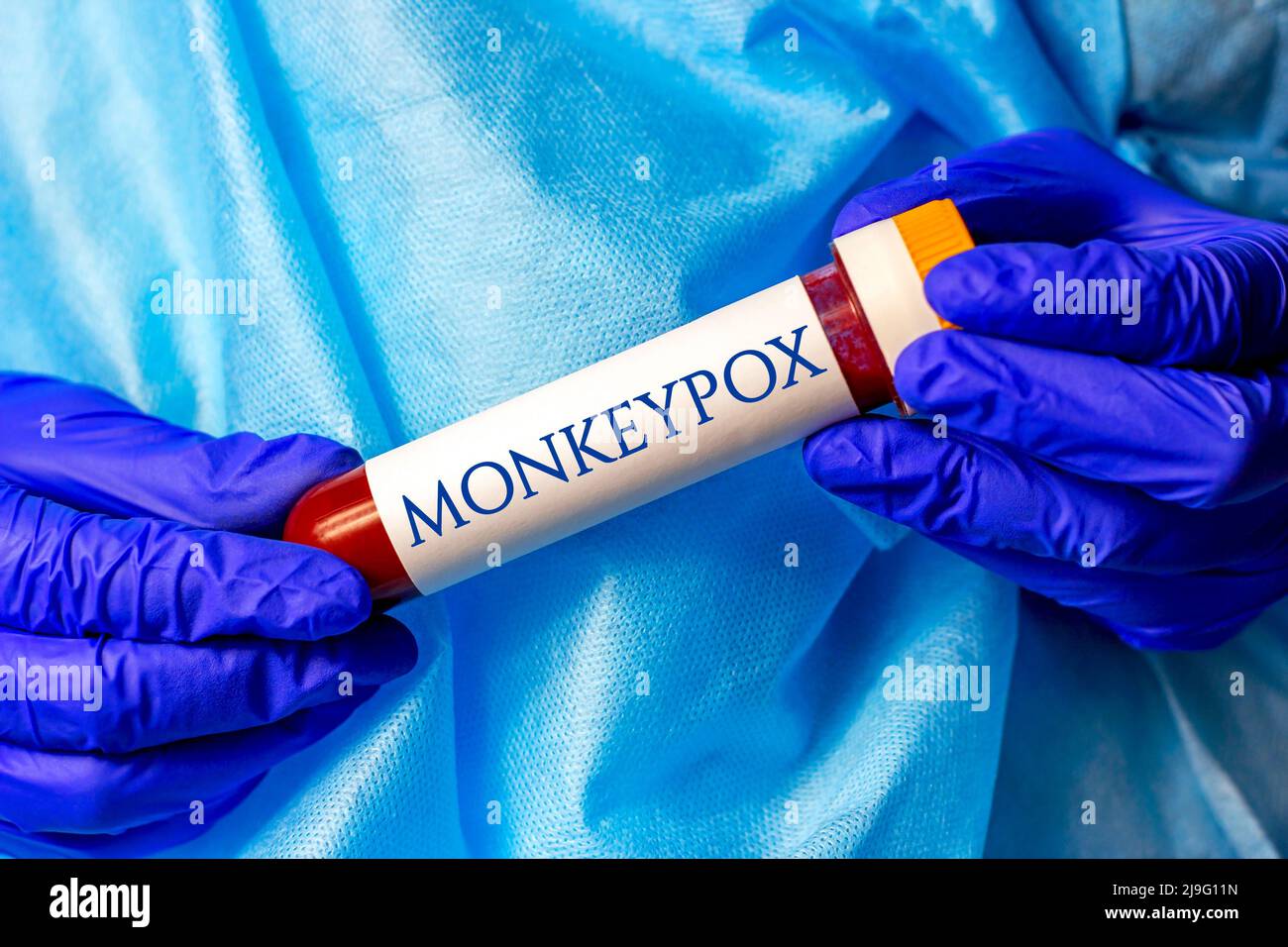 Nuovo campione infettivo della malattia del virus Monkeypox in provetta da laboratorio nella mano dello scienziato in guanto medico blu su sfondo chiaro. Foto Stock