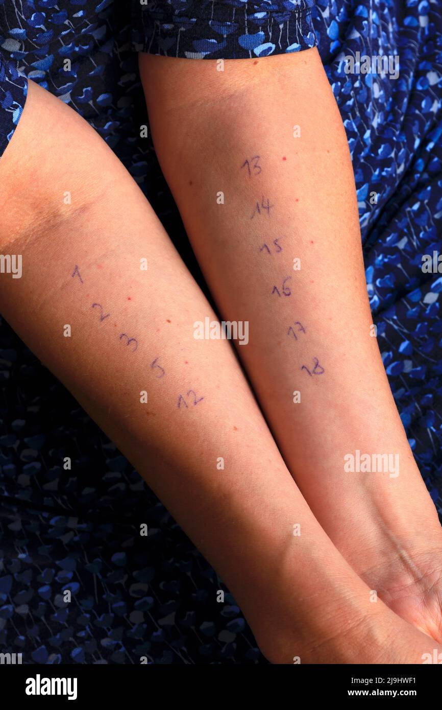 Mani di donna con numeri di test allergici Foto Stock