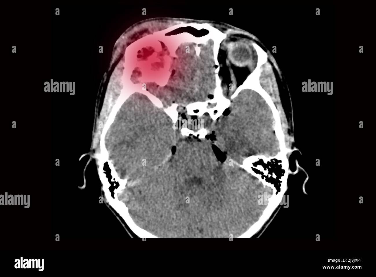 tomografia computerizzata del cervello con una frattura della parte frontale del cranio dopo aver ricevuto una lesione, un'inversione del cranio della testa dopo Foto Stock