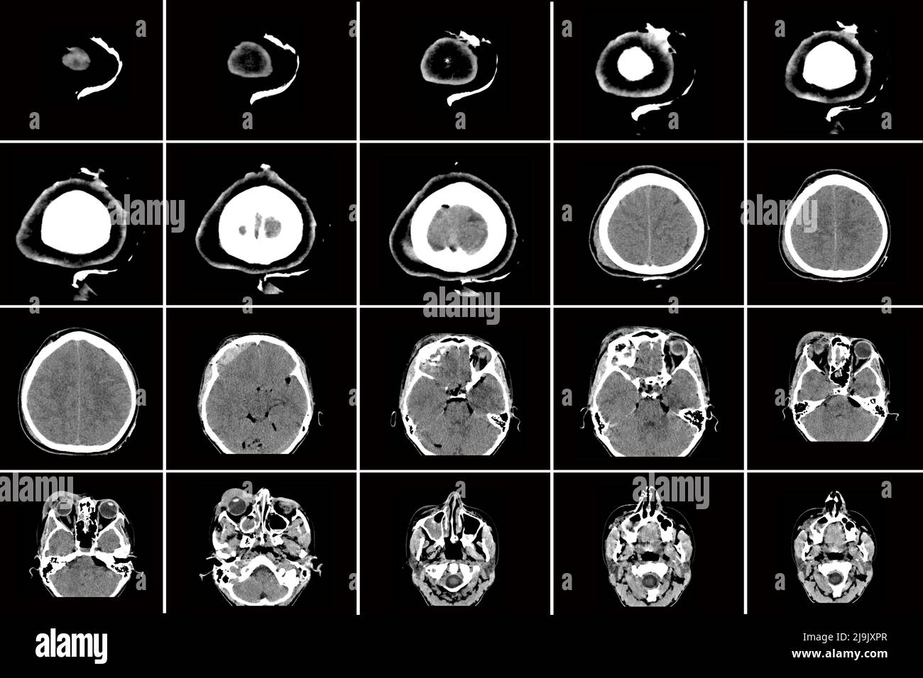 tomografia computerizzata del cervello con una frattura della parte frontale del cranio dopo aver ricevuto una lesione, un'inversione del cranio della testa dopo Foto Stock