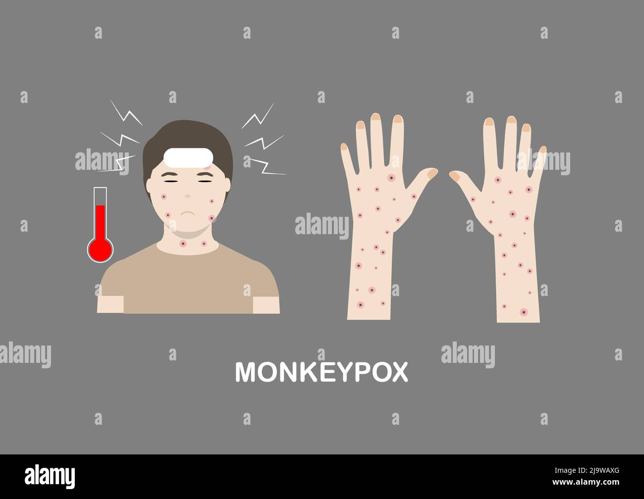 Illustrazione dei sintomi della scimmietta tra cui febbre, mal di testa ed eruzione cutanea sul viso, sul corpo e sulle estremità. Illustrazione Vettoriale