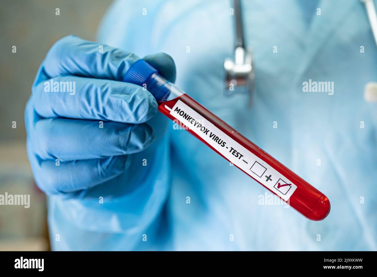 Infezione positiva da test del sangue da virus della scimmia Foto Stock