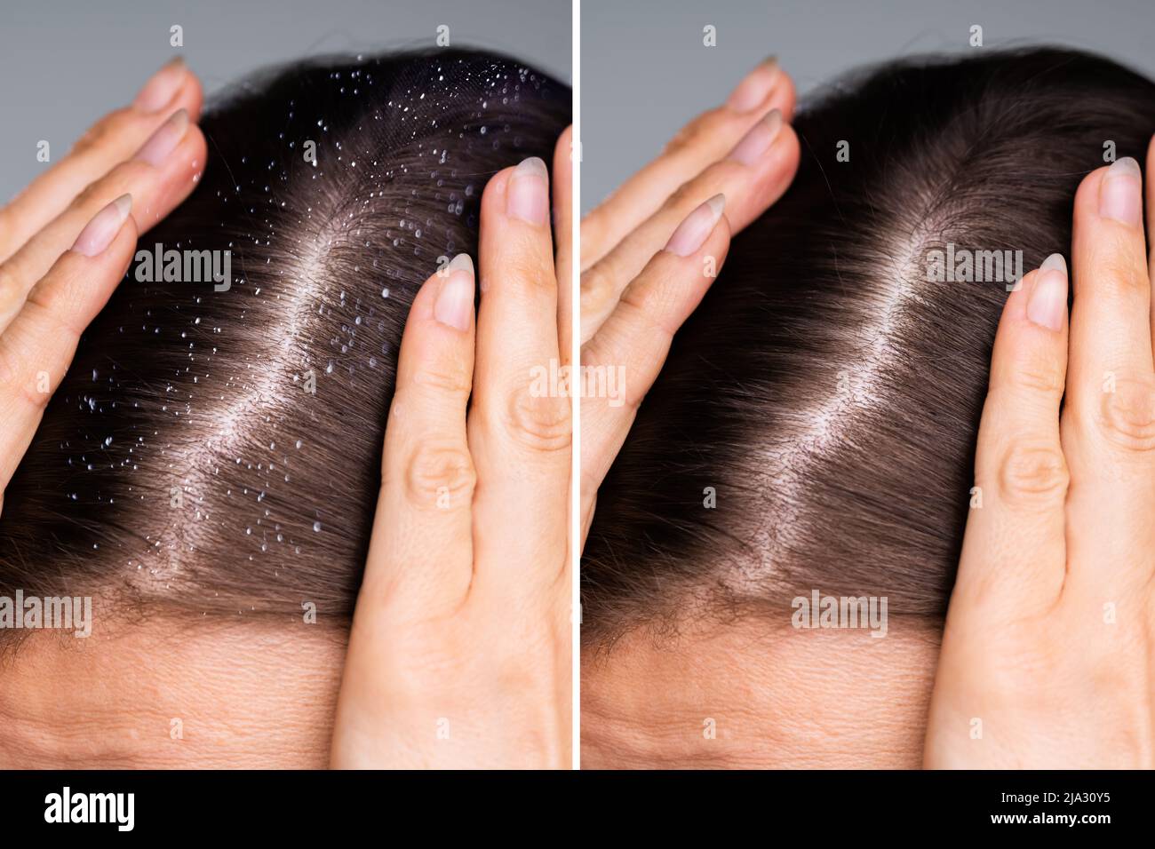 Differenza di capelli con forfora e i capelli puliti Foto Stock