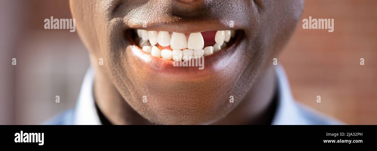 Chiudere la foto del giovane con dente mancante Foto Stock