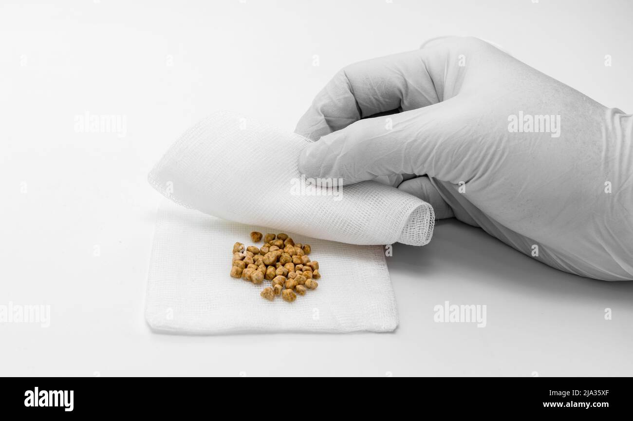 uomo che rivilera i gallstones rimossi che posano su un compress Foto Stock