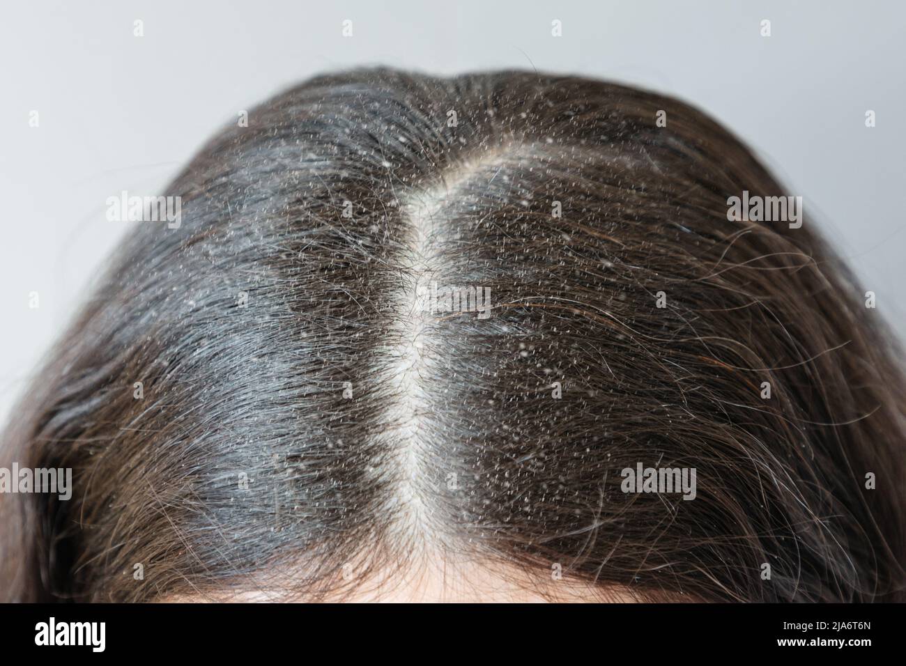 Primo piano della separazione dei capelli di brunette sulla testa ricoperta di forfora. Il concetto di dermatite seborroica. Foto Stock