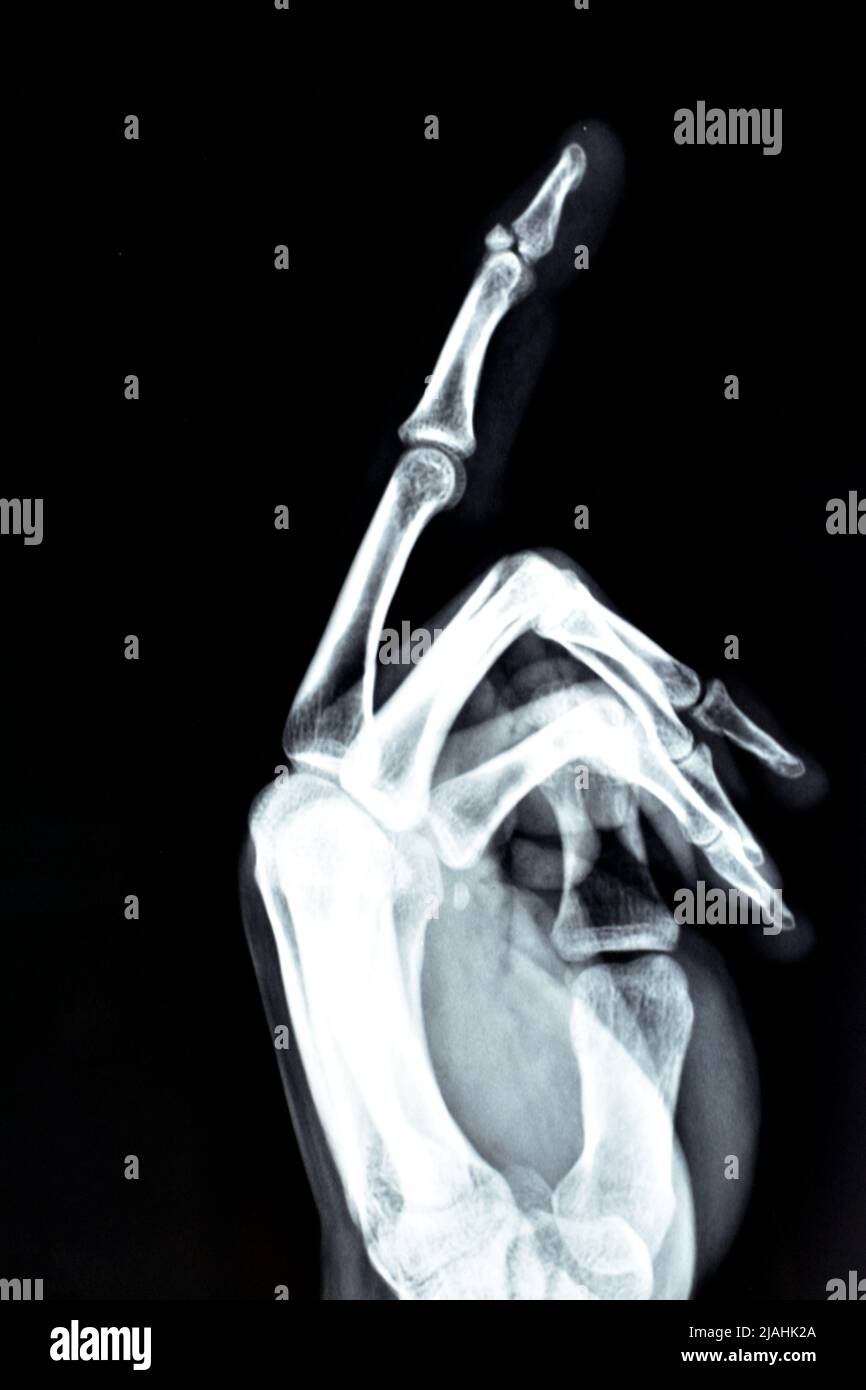 Frattura e spostamento di un piccolo pezzo di un osso della base della falanice distale del dito medio sinistro in una vista laterale di un raggio x semplice, s Foto Stock