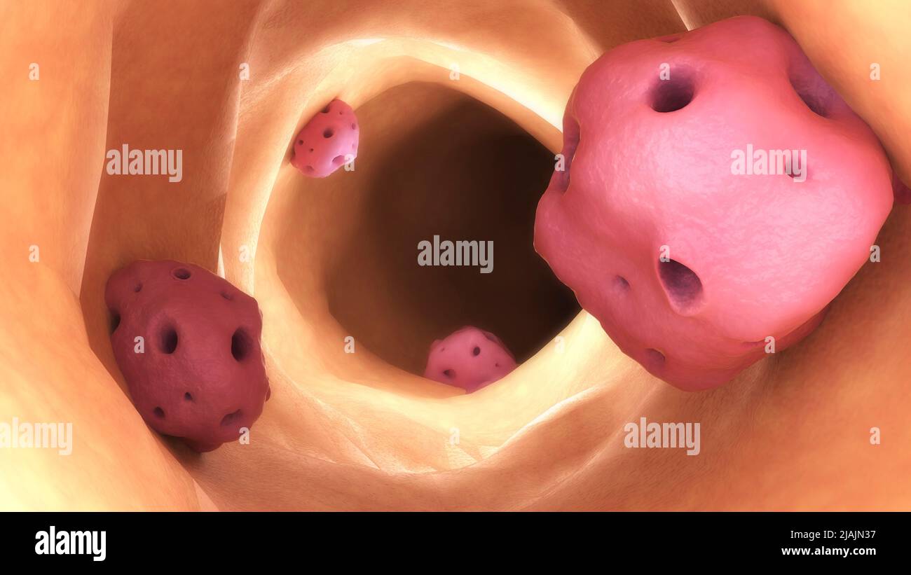 Illustrazione biomedica concettuale di Entamoeba all'interno dell'intestino. Foto Stock
