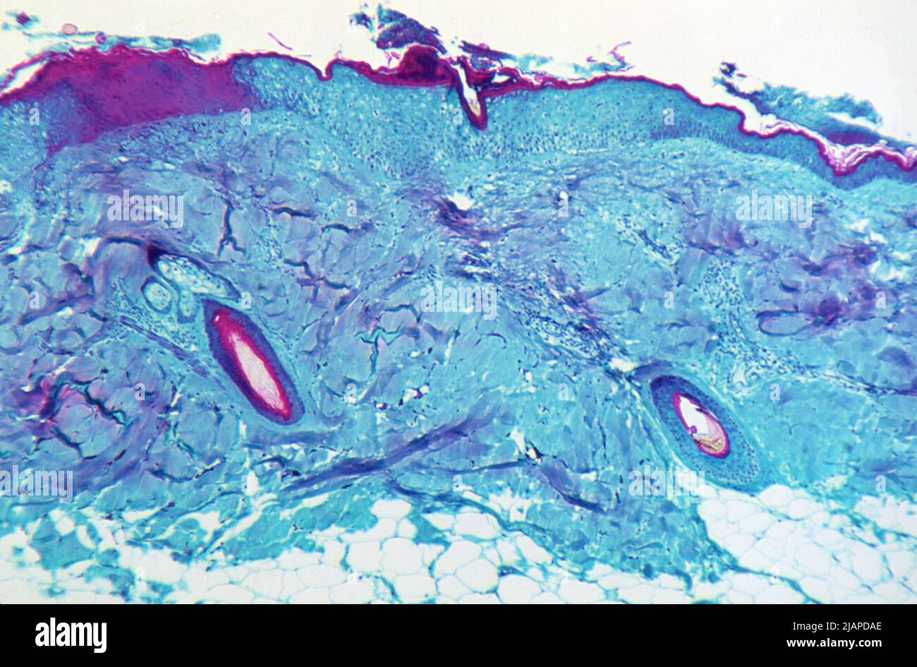Con un ingrandimento di 125X, questa immagine raffigurava una sezione di tessuto cutaneo, raccolto da una lesione sulla pelle di una scimmia, che era stata infettata con il virus della scimmia. Il campione è stato ottenuto il giorno 4 dello sviluppo di eruzione cutanea. Una versione ottimizzata e migliorata di un'immagine prodotta dai Centri statunitensi per il controllo e la prevenzione delle malattie / credito CDC Foto Stock