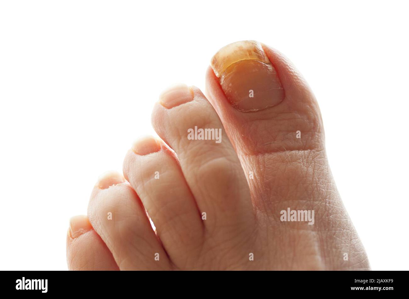 Piede femmina con chiodo a punta doppia grande in crescita. Foto Stock