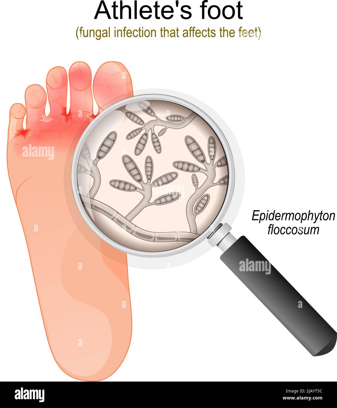 Piede dell'atleta. Infezione fungina che colpisce i piedi. Primo piano di epidermophyton floccosum fungi. Illustrazione vettoriale Illustrazione Vettoriale