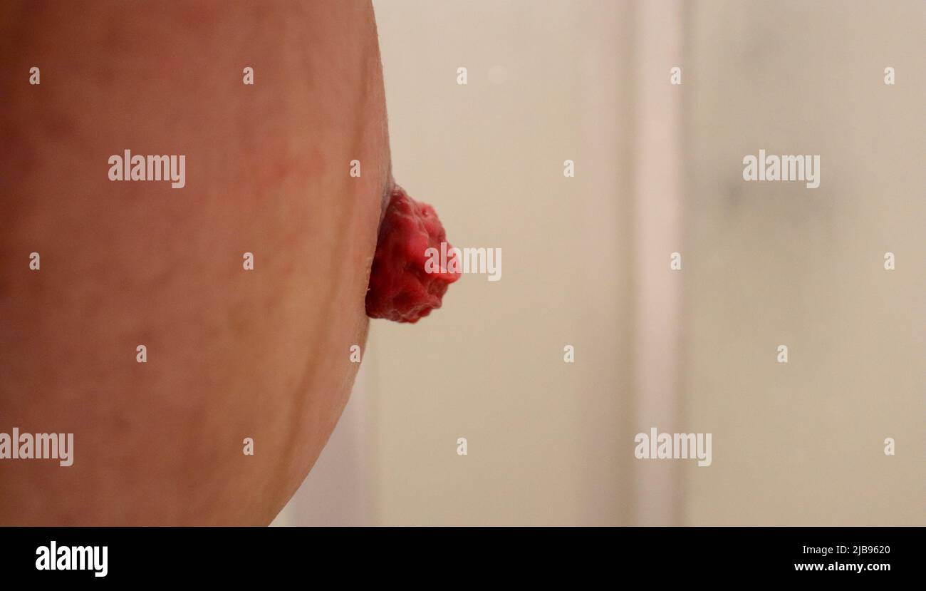 Uno stoma nell'addome in una persona in sovrappeso Foto Stock