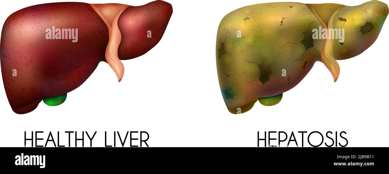Realismo umano interno organi fegato sano normale non sano composizione grassa con due colori diversi quando la malattia è presente vettore illustra Illustrazione Vettoriale