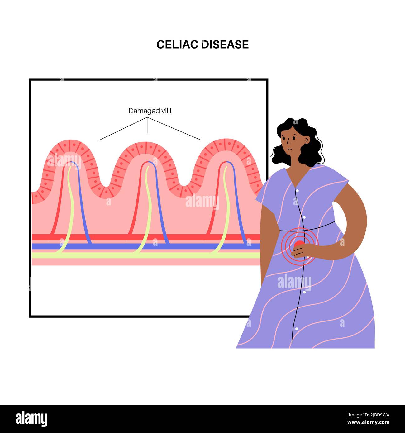 Infiammazione della celiachia, illustrazione Foto Stock