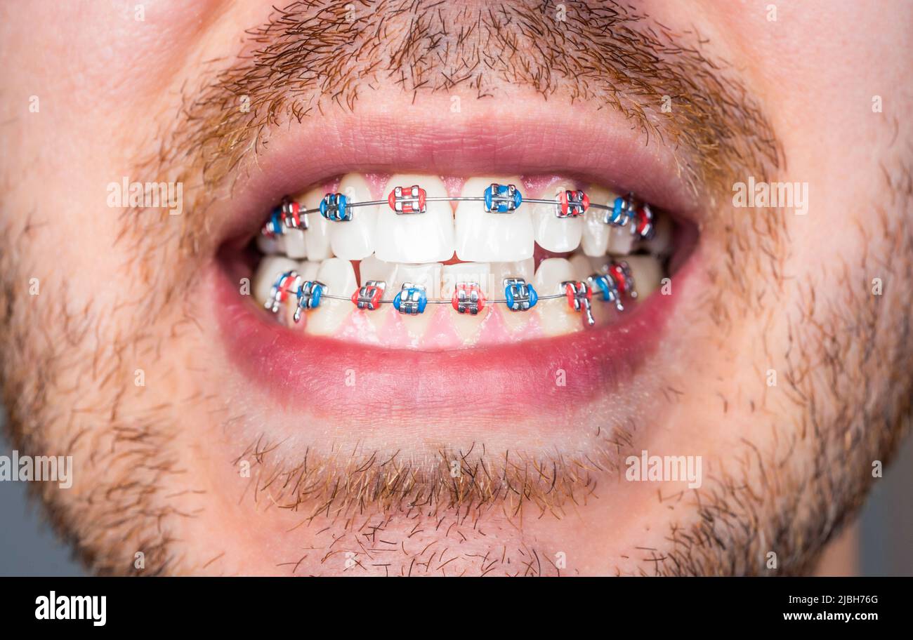 Uomo con bretelle. Sistema a staffa in bocca sorridente, macro denti fotografici, labbra ravvicinate, macro shot, dentista. Vicino ai denti si bretelle sui denti bianchi Foto Stock