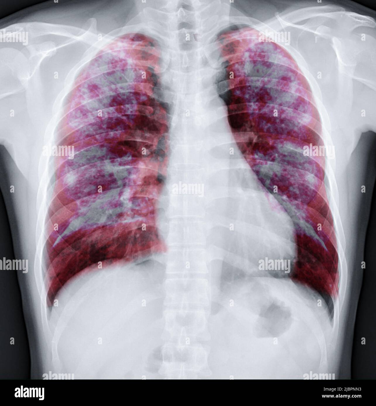 Fusione radiologica toracica con immagine di rendering Lung 3D per diagnosi TB,tuberculosis e covid-19 da CT-scanner 3D. Foto Stock