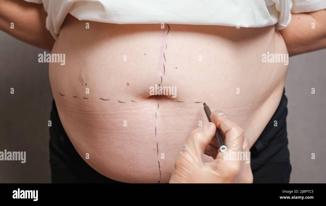 Il chirurgo disegna i segni di correzione sulla pancia per la chirurgia plastica Foto Stock
