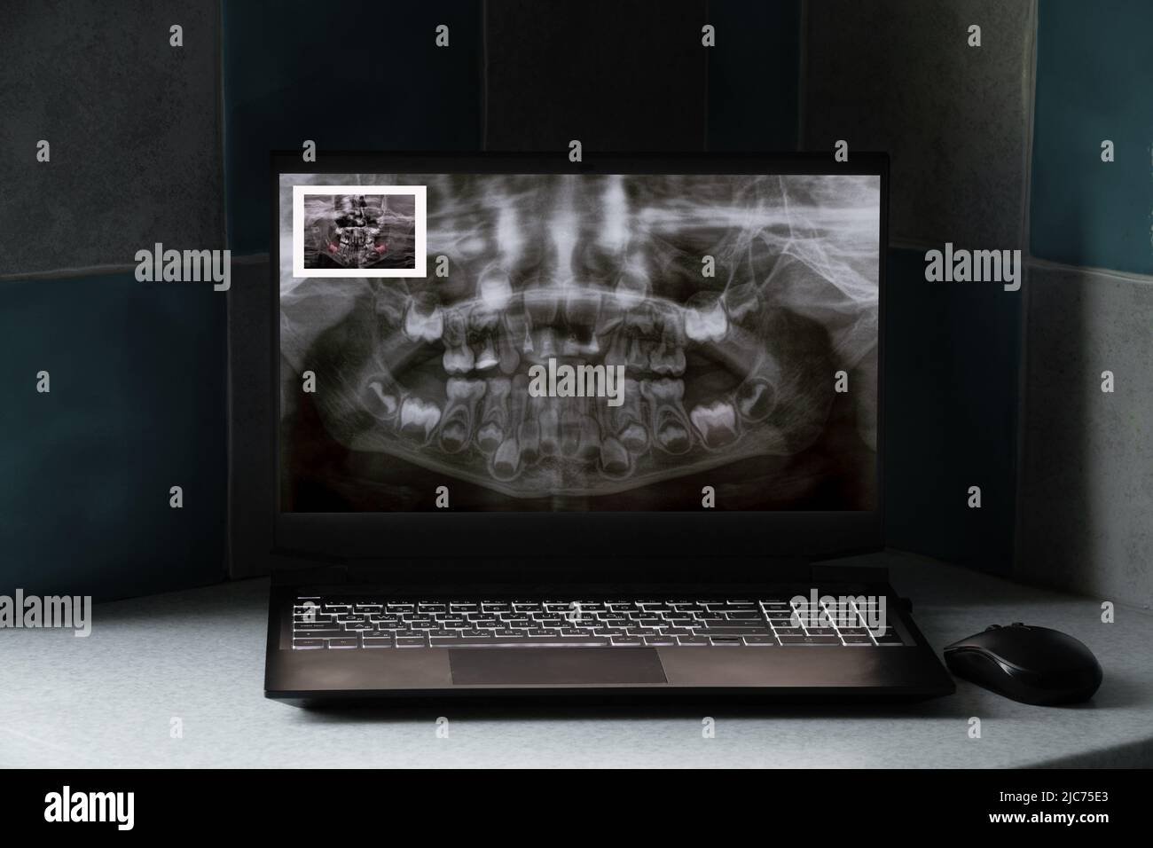 Raggi X panoramici dei denti dei bambini di due mascelle, ortopantomogramma dei denti dei bambini sugli schermi dei computer portatili sul tavolo Foto Stock
