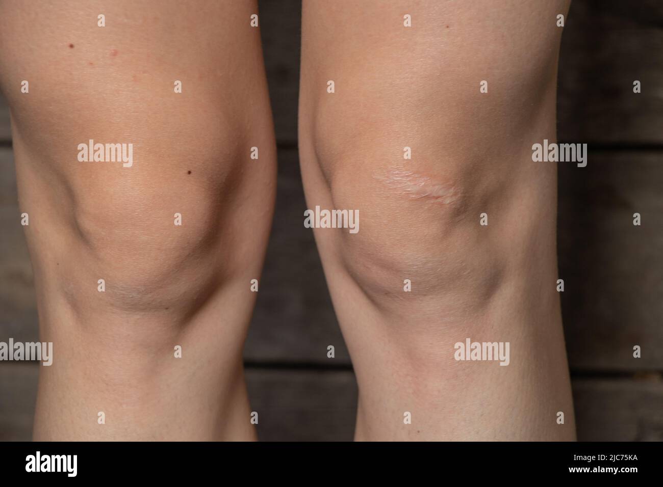 ginocchia di una giovane ragazza bianca con una cicatrice Foto Stock