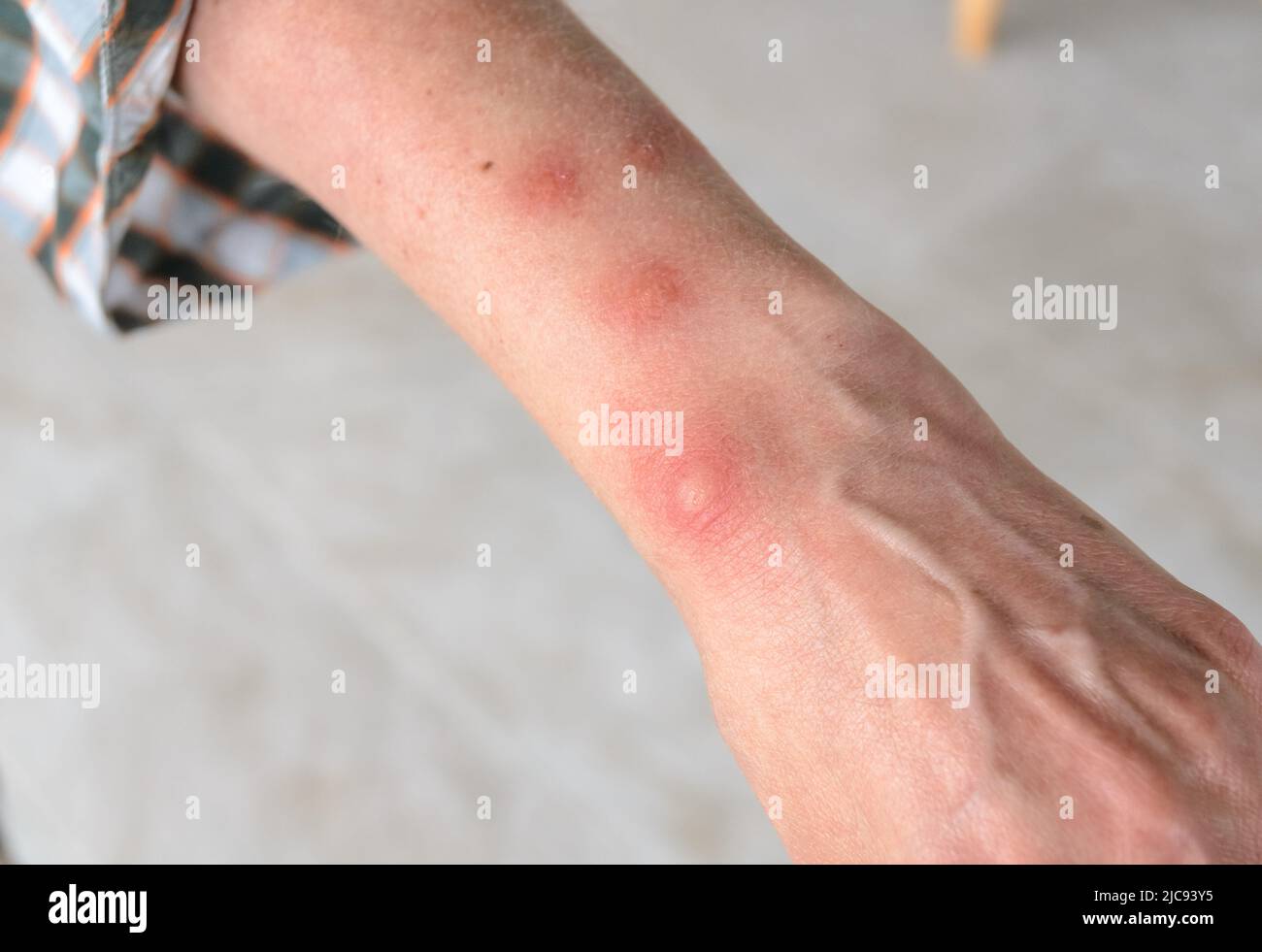 Reazione allergica a punture di insetto con macchie di gonfiore rotonde sul braccio di una donna Foto Stock