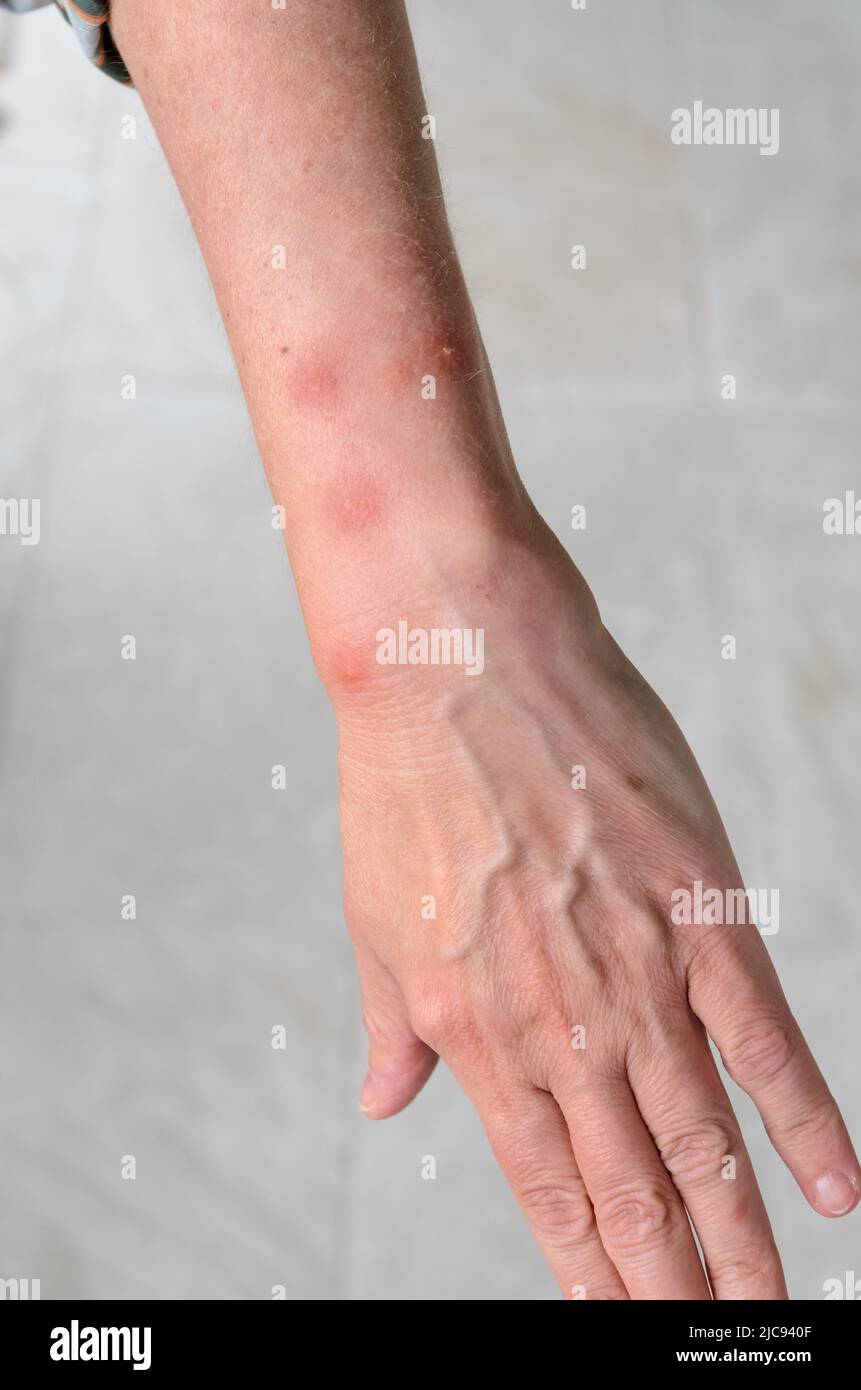 Reazione allergica a punture di insetto con macchie di gonfiore rotonde sul braccio di una donna Foto Stock