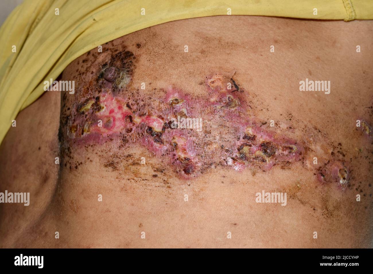 Infezione simplex da herpes al petto e addome dell'uomo asiatico. Foto Stock