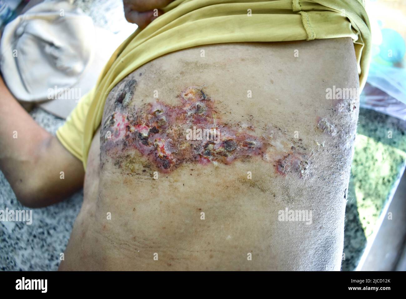 Infezione simplex da herpes al petto e addome dell'uomo asiatico. Foto Stock