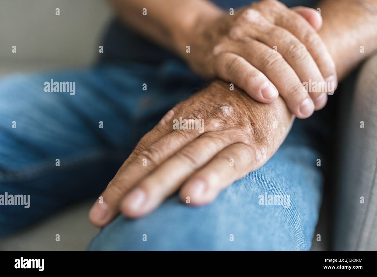Uomo anziano affetto da psoriasi, primo piano sulle mani Foto Stock