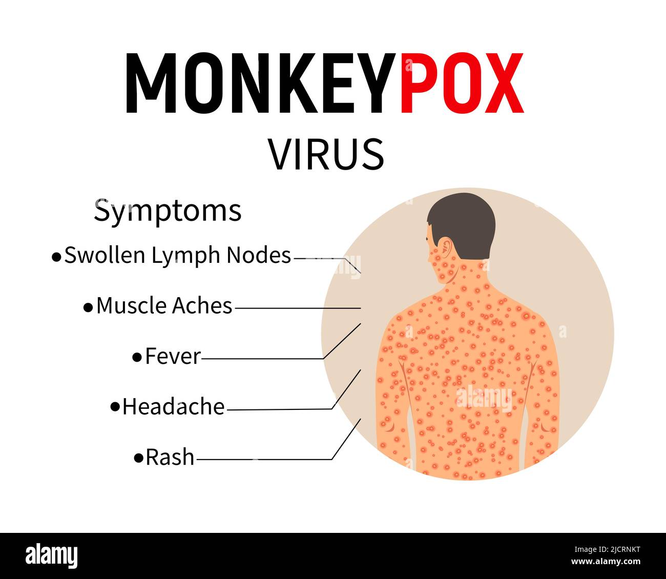 Sintomi della scimmietta. Infografica sulla malattia. Testo e uomo con rash e ulcere sul corpo. Sintomi della malattia - gonfiore dei linfonodi, dolore muscolare Illustrazione Vettoriale